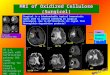 MRI of Oxidized Cellulose (Surgicel)