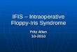 Ifis  intraoperative_floppy-iris_syndrome (reviewed)