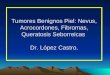Tumores Benignos Piel: Nevus, Acrocordones, Fibromas, Queratosis Seborreicas Dr. López Castro