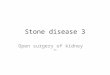 Stone disease 3 Open surgery of kidney 54. Surgical Management of Upper Urinary Tract Calculi 48 Kidney Calculi Pelolithotomy Nephrolithotomy Although
