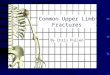 By Chris Pullen Common Upper Limb Fractures. Common Fractures Clavicle Proximal Humerus Distal radius Scaphoid