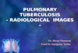 PULMONARY TUBERCULOSIS - RADIOLOGICAL IMAGES - Dr. Miron Ramona Conf Dr Antigona Trofor