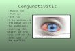 Conjunctivitis –Madras eye –Pink eye –Eye flu It is redness & inflammation of the membranes covering the whites of the eyes and on the inner part of the