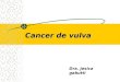 Cancer de vulva Dra. Jesica gabutti. Neoplasia intraepitelial de vulva Primera parte