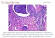 El caso del mes Enero 2014 Esta proliferación basaloide con empalizadas periféricas i hendiduras entre epitelio y estroma es un típico carcinoma basocelular;