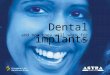 Dental implants and how they will work for you. Gli impianti dentali Astra Tech costituiscono un metodo sicuro ed affidabile per sostituire i denti, sia