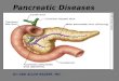 Presentation1.pptx pancreatic disease