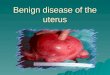 gynaecology.Benign tumor of the uterus.(dr.sundus)