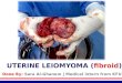 Uterine leiomyoma (fibroid)