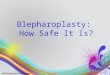 Blepharoplasty how safe it is