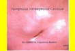 Neoplasia intraepitelial cervical[1]