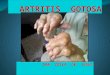 Artritis  gotosa