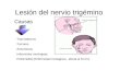 Lesión del nervio trigémino-dicertacion