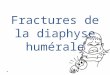 Fractures de la diaphyse humérale