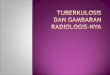 TUBERKULOSIS  DAN GAMBARAN RADIOLOGIS-NYA