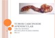 Tumor Carcinoide Apendicular