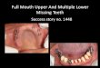 Replacement Of Missing Full Mouth Upper And Multiple Lower Teeth Using Implants