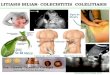 Colelitiasis y Colesistitis