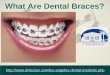 What are dental braces