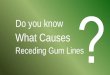 What Causes Receding Gums?