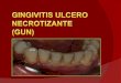 Gingivitis ulcero necrotizante (gun)