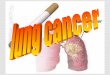 lung cancer What is cancer of the lung?