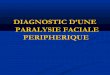 Paralysie faciale périphérique