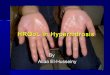 Hyperhidrosis 5