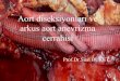 Aort diseksiyonları ve arkus aort anevrizma cerrahisi  dr. suat buket