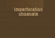 Imperforation choanale