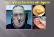Paralysie faciale périphérique post otitique