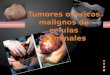 Tumores ovaricos malignos de celulas germinales
