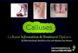 Calluses information & treatment