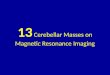 13 cerebellar masses on magnetic resonance imaging