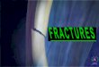 1.3.2 Fractures