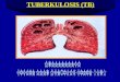 Tuberkulosis Paru V