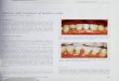 Etiology and Treatment of Sensitive Teeth
