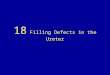 18 filling defects in the ureter