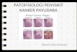 Patofisiologi Penyakit Kanker Payudara