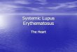 Systemic Lupus Erythematosus Heart