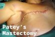 Patey’s Mastectomy. Patey’s (Radical) Mastectomy Sandeep Kumar MS FRCS (Edinburgh) PhD (Wales) MMSc (Newcastle) Professor of Surgery Department of Surgery