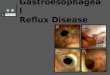 Gastroesophageal Reflux Disease. “a prevalent and chronic condition in which reflux of the stomach contents into the oesophagus causes a range of troublesome
