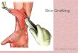 Skin Grafting By: Megan French. The Skin  The skin is the largest organ of the body  3 main layers : Epidermis, Dermis, Subcutaneous  Regulates body