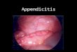 Appendicitis. Pathophysiology Obstruction of lumen causes diffuse pain Intraluminal bacterial overgrowth causes: –Mucosal breakdown –Bacterial invasion