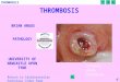 THROMBOSIS 1 BRIAN ANGUS PATHOLOGY UNIVERSITY OF NEWCASTLE UPON TYNE Coronary artery thrombosis Return to Cardiovascular Pathology Index Page