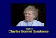 926-4 Charles Bonnet Syndrome. Charles Bonnet: French philosopher and natural scientist born March 13, 1720. Geneva died May 20, 1793. Genthod near Geneva