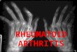 RHEUMATOID ARTHRITIS. Chronic multisystem disease of unknown cause Characteristic features: Persistent inflammatory synovitis Involves peripheral joints