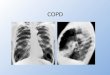COPD. Objectives How important is COPD? What is COPD? How to treat COPD? What is the prognosis?