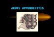 ACUTE APPENDICITIS. Acute appendicitis is an inflammation of a vermiform appendix caused by purulent microflora. Approximately 7 percent of the population