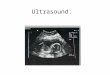 Ultrasound:. Machine Using sound waves to look at physical features of the developing fetus including size, anatomy, number of appendages/parts, sex,